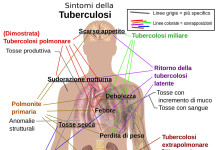 UK : Londra esplode TUBERCOLOSI – ‘Abbiamo smesso lo screening delle persone per questa malattia’