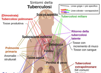 UK : Londra esplode TUBERCOLOSI – ‘Abbiamo smesso lo screening delle persone per questa malattia’