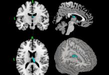 Deep Brain Stimulation Decreases Tics in Young Adults with Severe Tourette Syndrome
