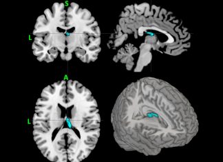 Deep Brain Stimulation Decreases Tics in Young Adults with Severe Tourette Syndrome