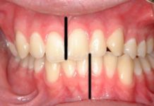 A Crooked Bite May Indicate Early Life Stress