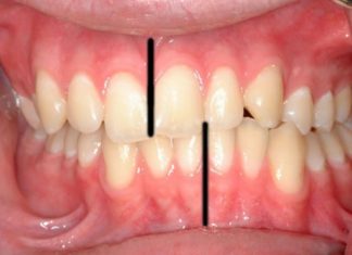A Crooked Bite May Indicate Early Life Stress