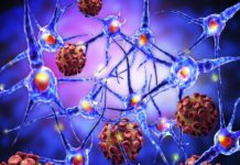 More Multiple Sclerosis Causing Mutations Found in Canadian Families
