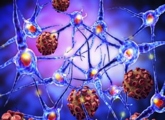 More Multiple Sclerosis Causing Mutations Found in Canadian Families