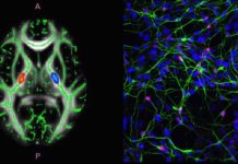 Common Drug Could Help Treat ALS and SMA