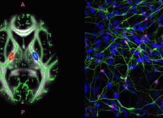 Common Drug Could Help Treat ALS and SMA