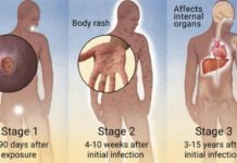 SYPHILIS STRIKE BACK – The problem of medicines