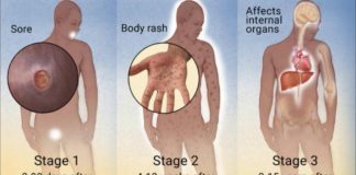 SYPHILIS STRIKE BACK – The problem of medicines