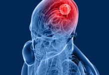 Discovered Enzyme That Allows Brain Tumor Growth