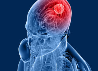 Discovered Enzyme That Allows Brain Tumor Growth