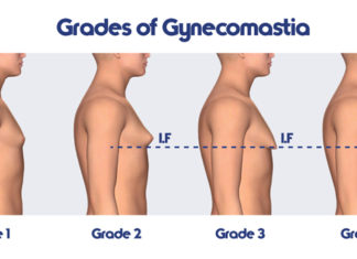 Breast reduction surgery quadruples among british man