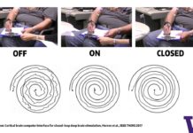 Brain Signals Deliver Targeted Treatment for World’s Most Common Movement Disorder