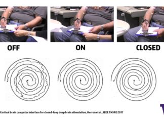 Brain Signals Deliver Targeted Treatment for World’s Most Common Movement Disorder