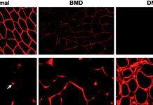 Designed Proteins May Help Treat Muscular Dystrophy