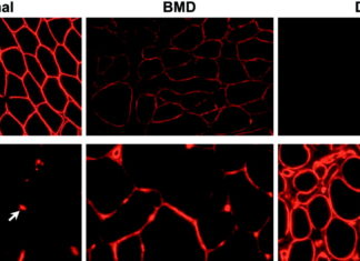 Designed Proteins May Help Treat Muscular Dystrophy
