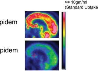 Insomnia Medication May Wake Some Patients From Vegetative State