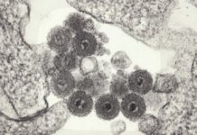 Hidden Herpes Virus May Play Role in Multiple Sclerosis and Other Brain Disorders