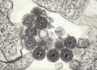 Hidden Herpes Virus May Play Role in Multiple Sclerosis and Other Brain Disorders
