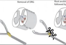 New surgical strategy offers hope for repairing spinal injuries