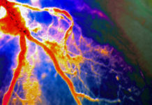 Anti-inflammatory cuts risk of heart attack