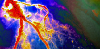 Anti-inflammatory cuts risk of heart attack