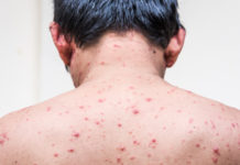 Chickenpox Virus Fatal in Newly Discovered Immunodeficiency