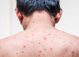 Chickenpox Virus Fatal in Newly Discovered Immunodeficiency