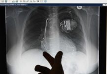 465000 Pacemakers vulnerable – users must visit doctors for fix