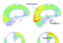 Coma: Nerve Stimulation Restores Consciousness