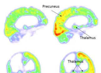 Coma: Nerve Stimulation Restores Consciousness