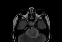 Brain cancer growth halted by absence of protein