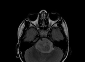 Brain cancer growth halted by absence of protein