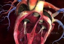 Umbilical cord stem cells show promise as heart failure treatment