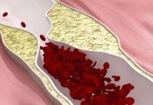 New therapeutic strategy to treat peripheral vascular disease