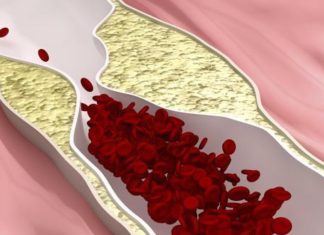 New therapeutic strategy to treat peripheral vascular disease