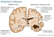 Could Alzheimer’s Be a Disorder of Energy Metabolism?