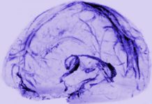First evidence of the body’s waste system in the human brain discovered