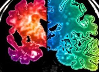 Mechanism Explains How Seizures May Lead to Memory Loss