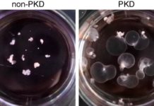 Mini-kidneys grown in lab reveal renal disease secrets