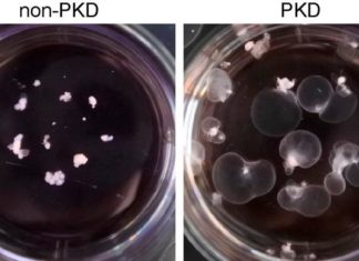 Mini-kidneys grown in lab reveal renal disease secrets
