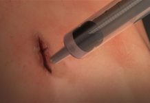 Squirtable elastic surgical glue seals wounds in 60 seconds