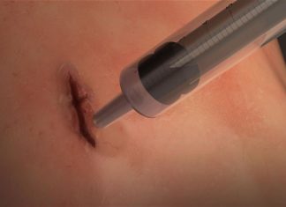 Squirtable elastic surgical glue seals wounds in 60 seconds