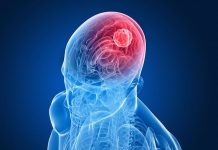 New Approach to Destroying Deadly Brain Tumors