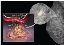 Blood test can effectively rule out breast cancer, regardless of breast density