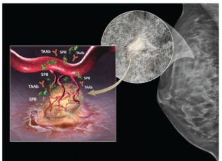 Blood test can effectively rule out breast cancer, regardless of breast density