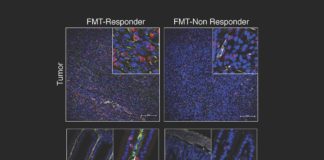 Bacteria in the gut modulates response to immunotherapy in melanoma