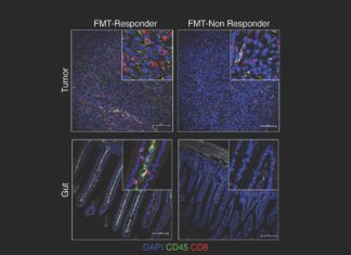 Bacteria in the gut modulates response to immunotherapy in melanoma