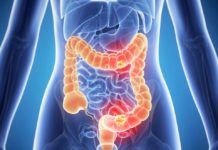 Colon cancer breakthrough could lead to prevention – the foods that can help