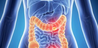 Colon cancer breakthrough could lead to prevention – the foods that can help