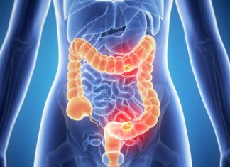 Colon cancer breakthrough could lead to prevention – the foods that can help